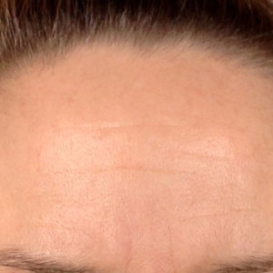 Złuszczanie a przebarwienia - Uroda 40 plus