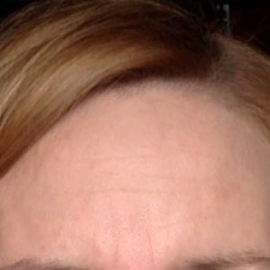 Złuszczanie a przebarwienia - Uroda 40 plus