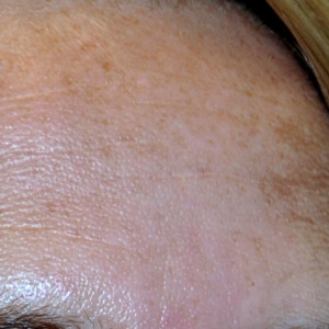 Złuszczanie a przebarwienia - Uroda 40 plus