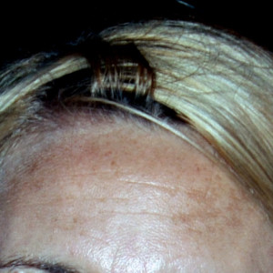 Złuszczanie a przebarwienia - Uroda 40 plus