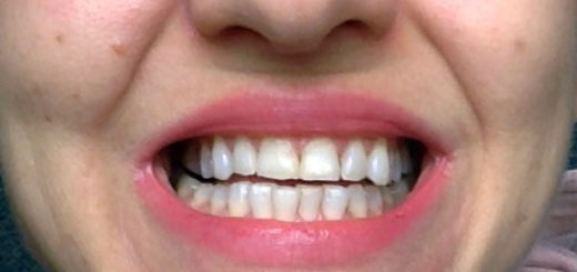 Uroda 40 plus - Wybielanie zębów metodą nakładkową